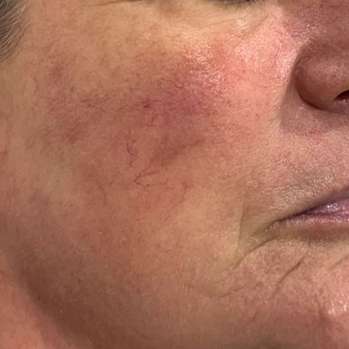 After — Facial redness & visible capillaries