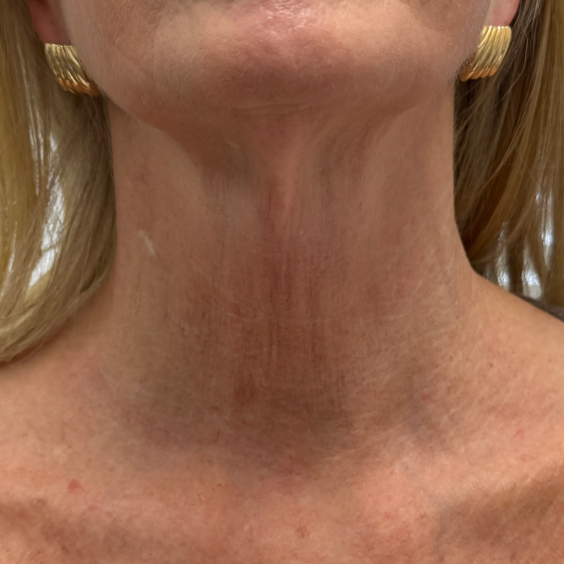 After — Sun damage & pigmentation