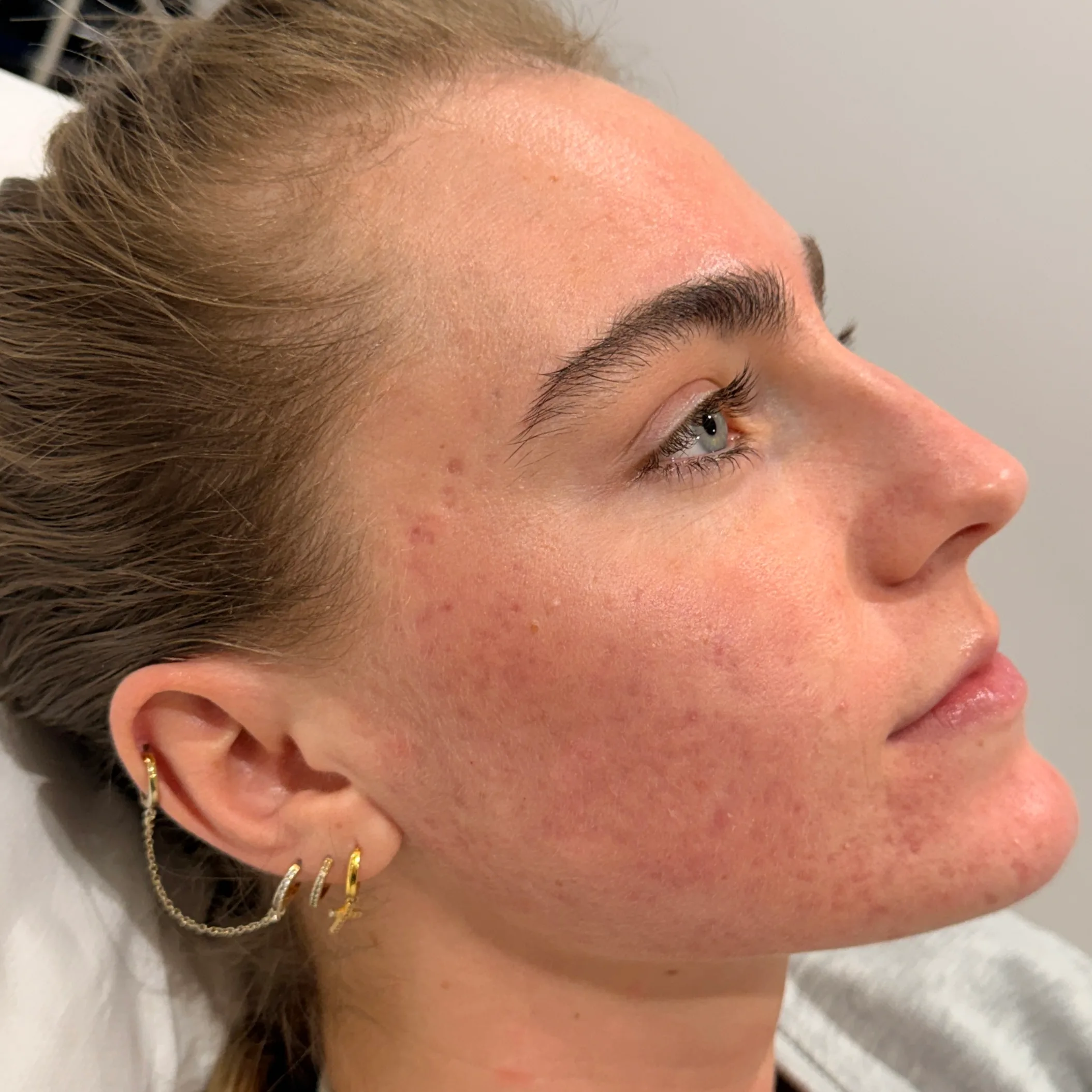 After — Acne scarring, congestion & uneven skin texture