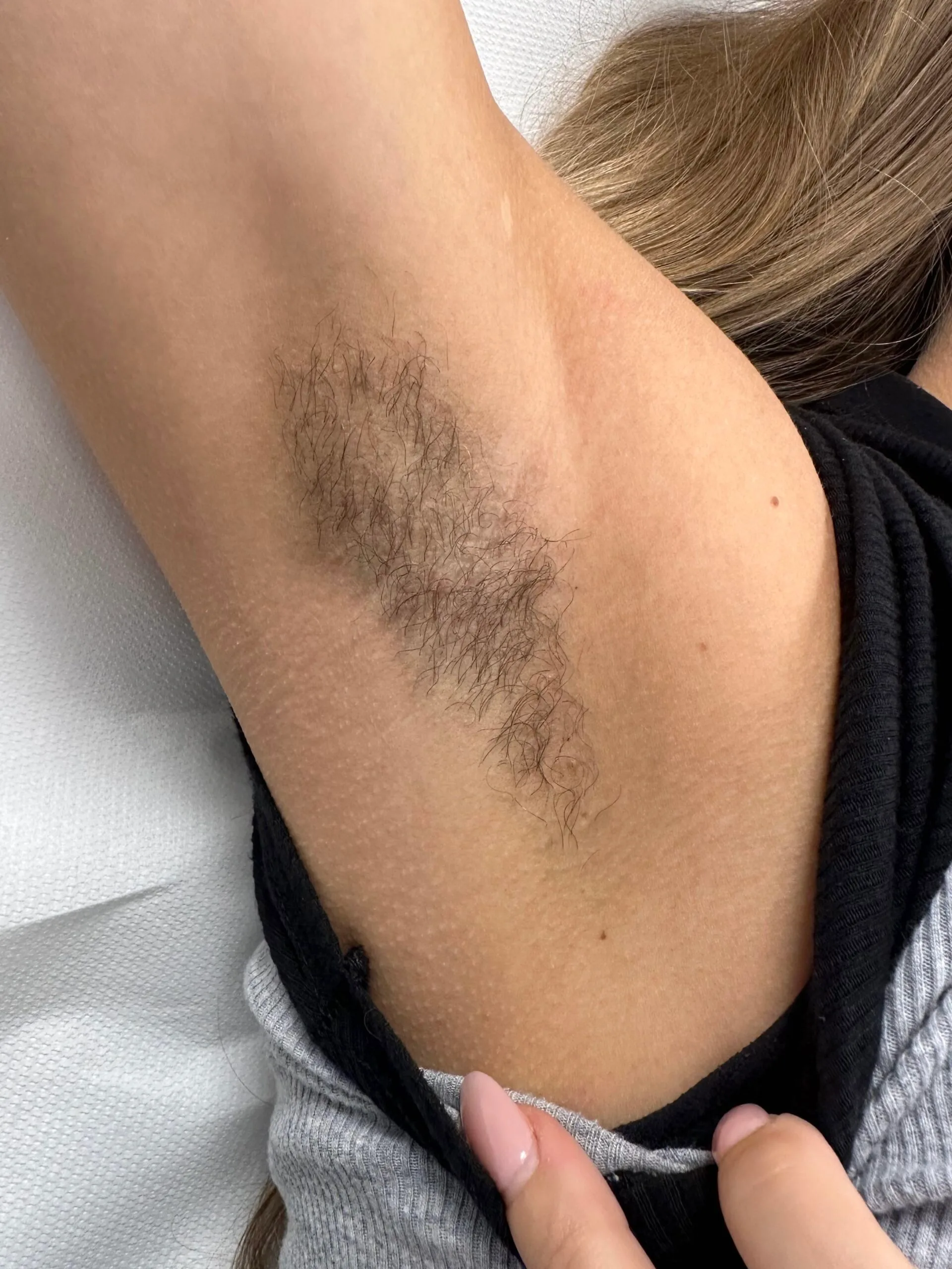 Before — Long-term hair reduction