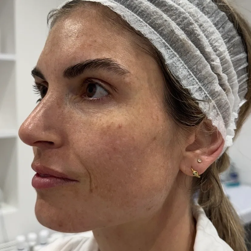 Before — Pigmentation · texture · skin quality