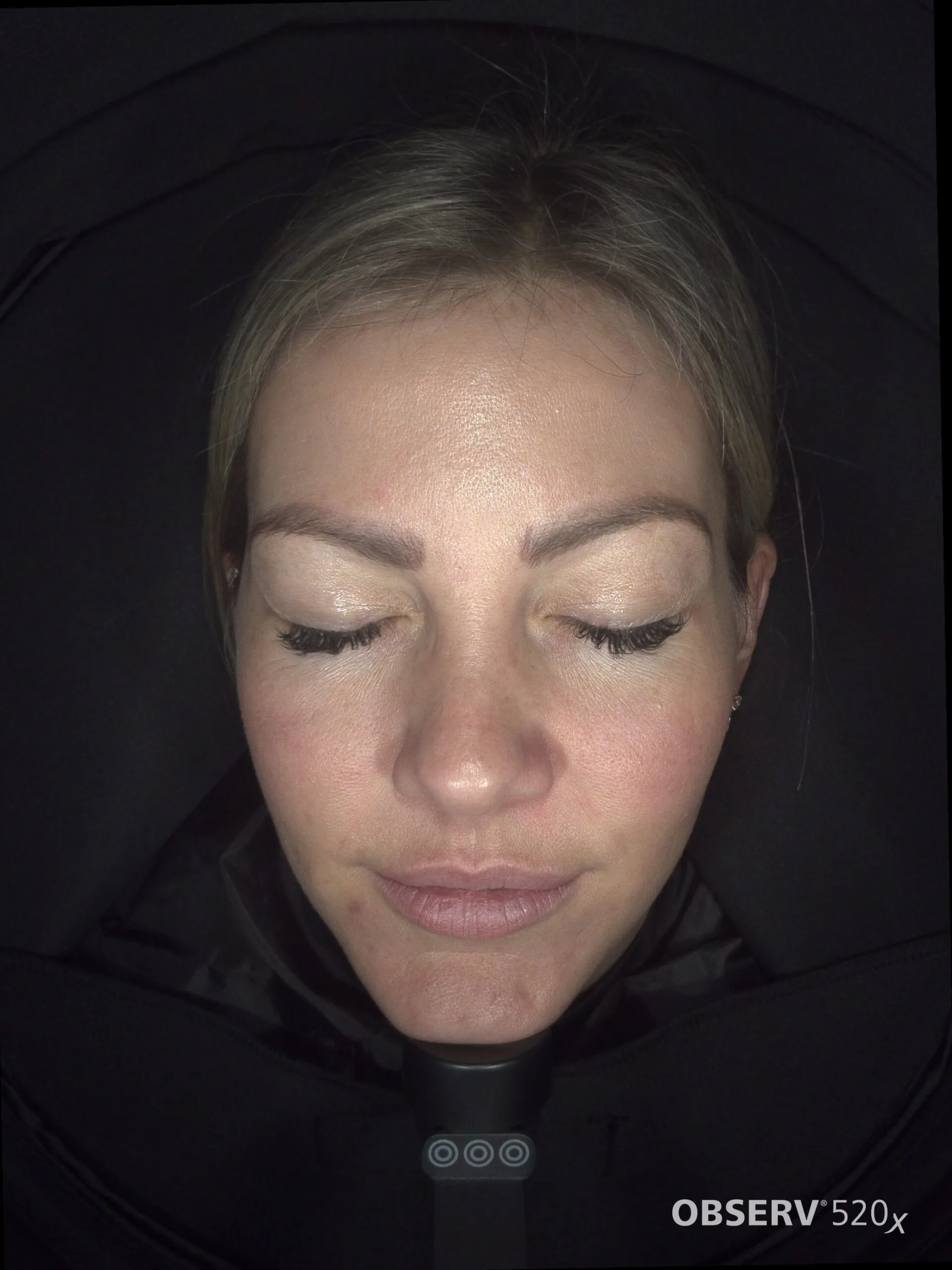 After Lumecca IPL — pigmentation improvement