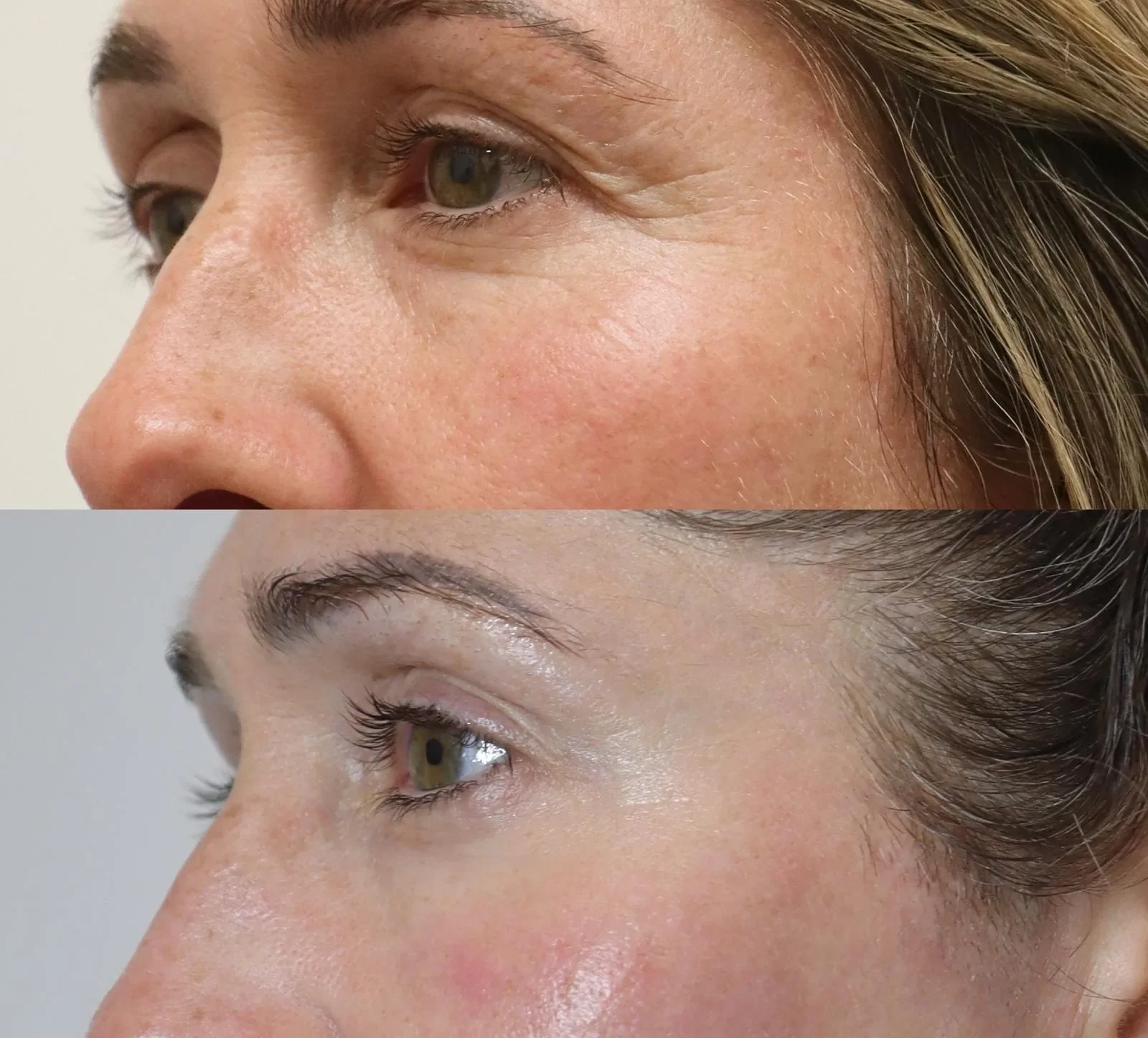 Periorbital skin before and after NeoGen Plasma treatment